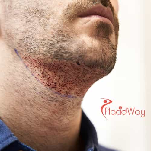 Beard Hair Transplant in Turkey for US Patients